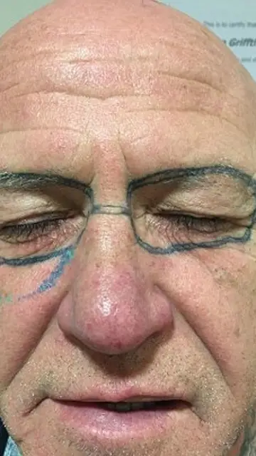 Se tatúa unas gafas de sol en la cara después de una borrachera Se tatúa unas gafas de sol en la cara después de una borrachera