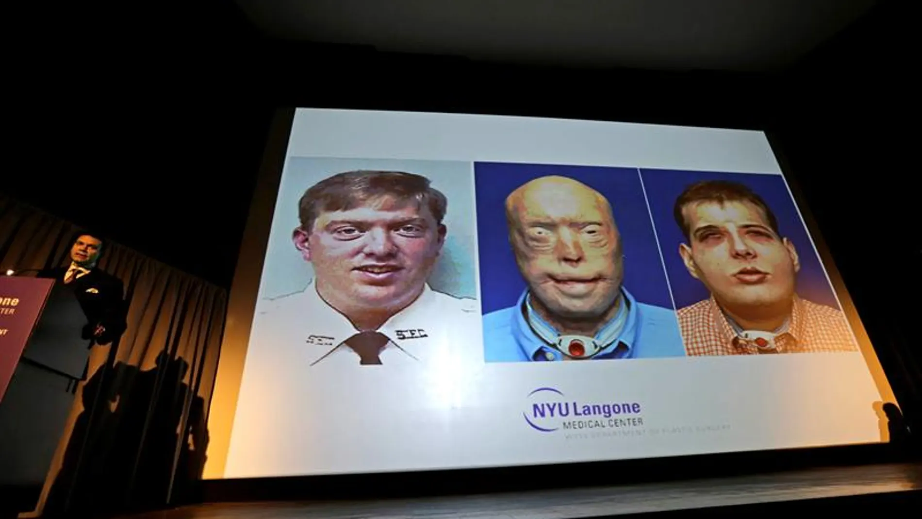 Imagen del trasplante de cara realizado en EEUU