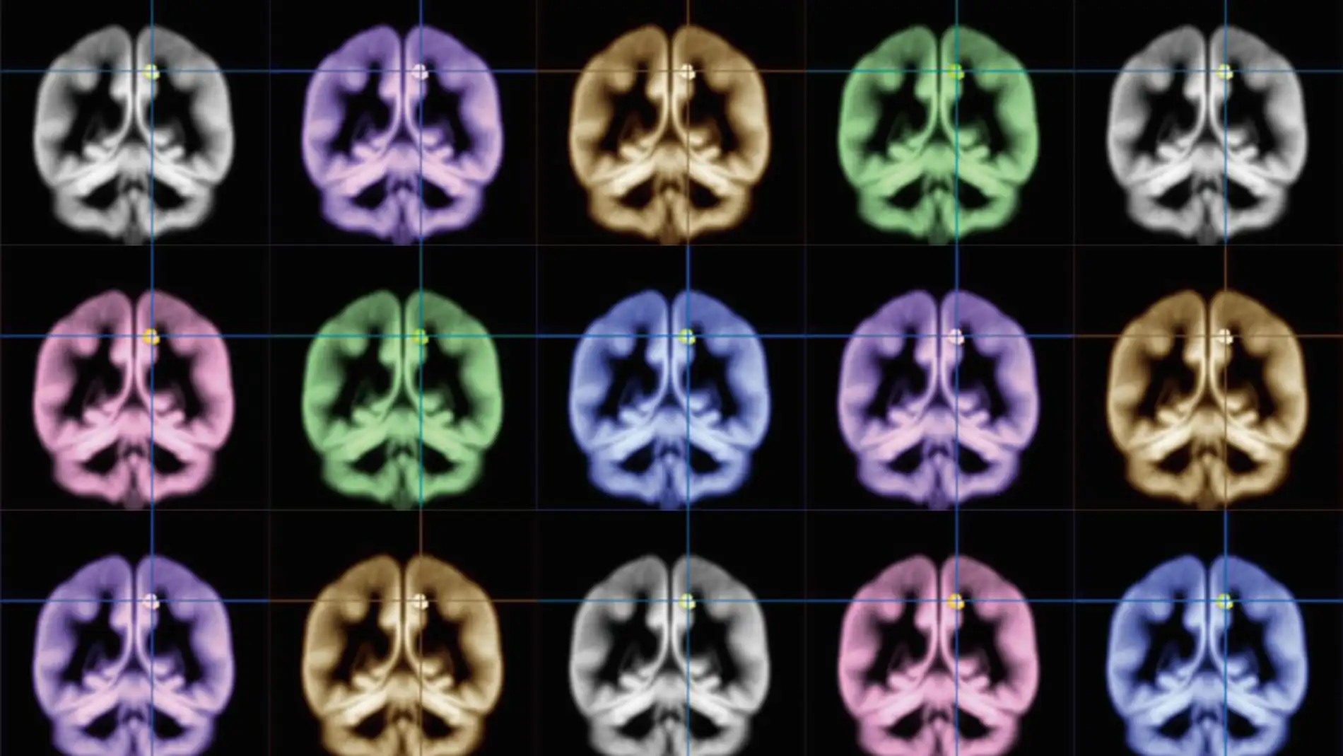 Escáner cerebral 