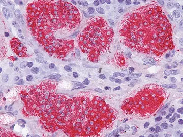 Cáncer por un virus intestinal Cáncer por un virus intestinal