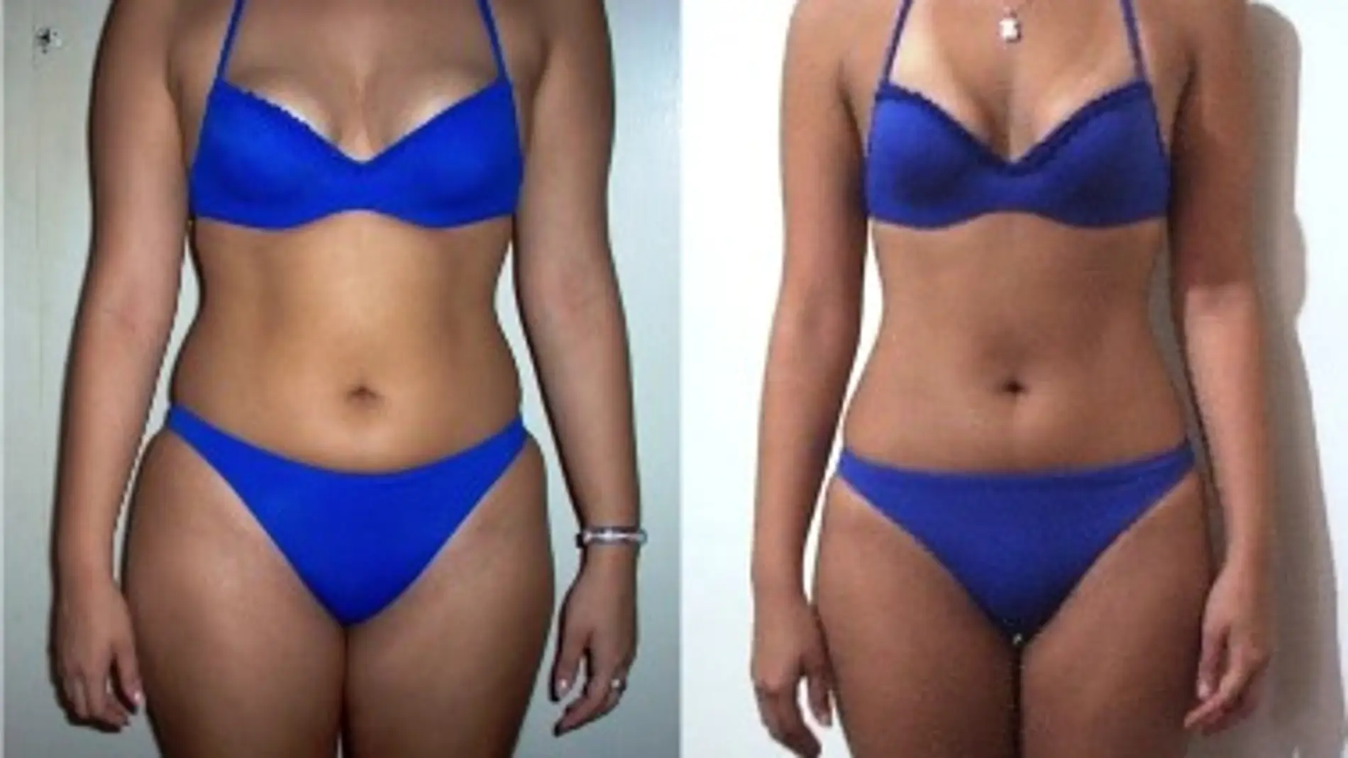 Fotos paciente sometido a dieta para baj