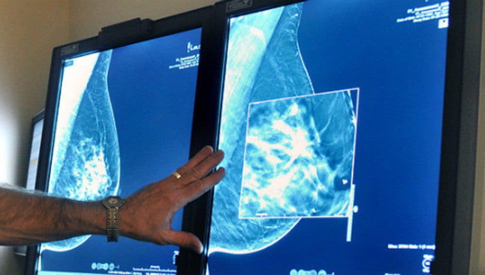 Imagen de archivo de un diagnóstico de cáncer de mama
