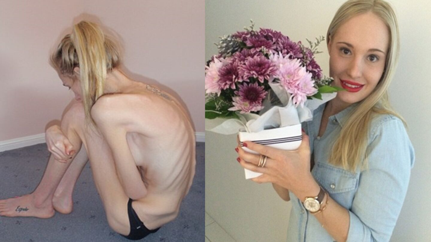 Una joven con anorexia muestra su recuperaci&oacute;n ocho a&ntilde;os despu&eacute;s de estar al borde de la muerte