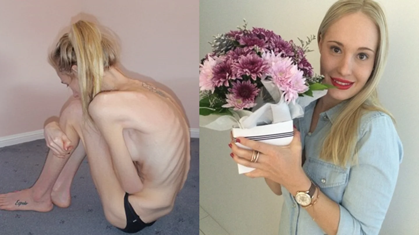 Una joven con anorexia muestra su recuperación ocho años después de estar al borde de la muerte Una joven con anorexia muestra su recuperación ocho años después de estar al borde de la muerte