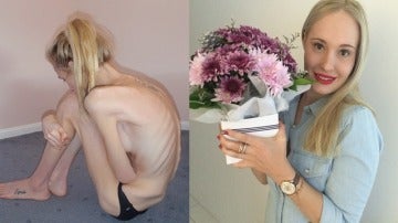 Una joven con anorexia muestra su recuperación ocho años después de estar al borde de la muerte