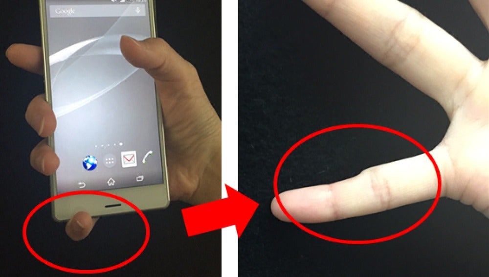 Ejemplo de un dedo deformado por sujetar el móvil