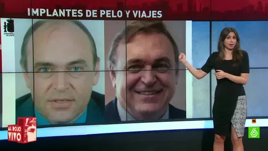 Los implantes de pelo del director de AcuaMed Los implantes de pelo del director de AcuaMed