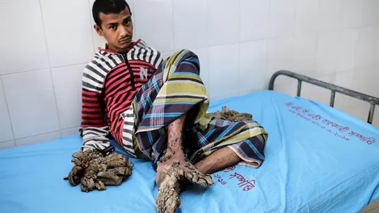 Paciente diagnosticado con epidermodisplasia verruciforme Paciente diagnosticado con epidermodisplasia verruciforme