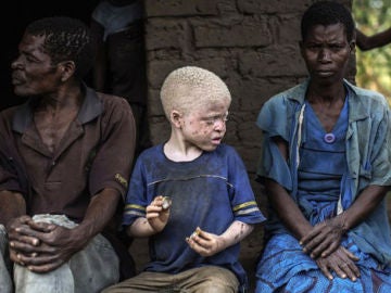 Los niños albinos son perseguidos por la superstición y la magia negra Los niños albinos son perseguidos por la superstición y la magia negra
