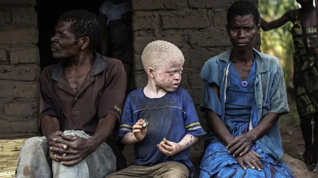 Los niños albinos son perseguidos por la superstición y la magia negra Los niños albinos son perseguidos por la superstición y la magia negra