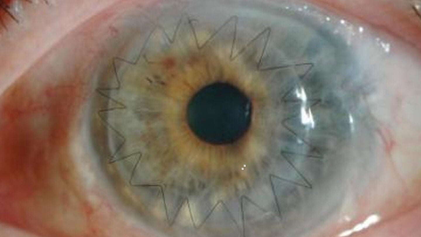 Imagen de un ojo despu&eacute;s de un trasplante de c&oacute;rnea