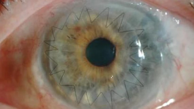 Imagen de un ojo después de un trasplante de córnea Imagen de un ojo después de un trasplante de córnea