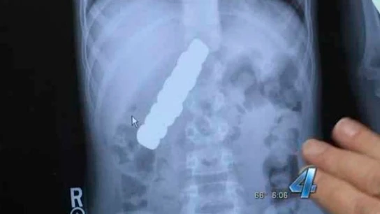 Radiografía que muestra los imanes en el estómago del niño Radiografía que muestra los imanes en el estómago del niño