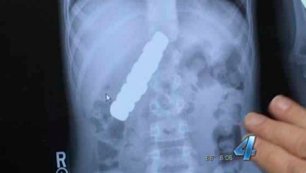Radiografía que muestra los imanes en el estómago del niño