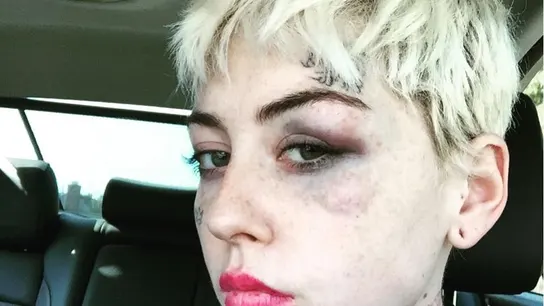 Illma Gore con las marcas del puñetazo recibido en la cara Illma Gore con las marcas del puñetazo recibido en la cara