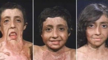 Zubaida, una niña con el rostro quemado tras un accidente