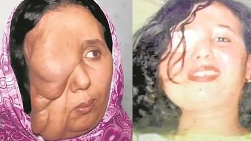 Samira Benhar antes y después de su operación de rostro Samira Benhar antes y después de su operación de rostro
