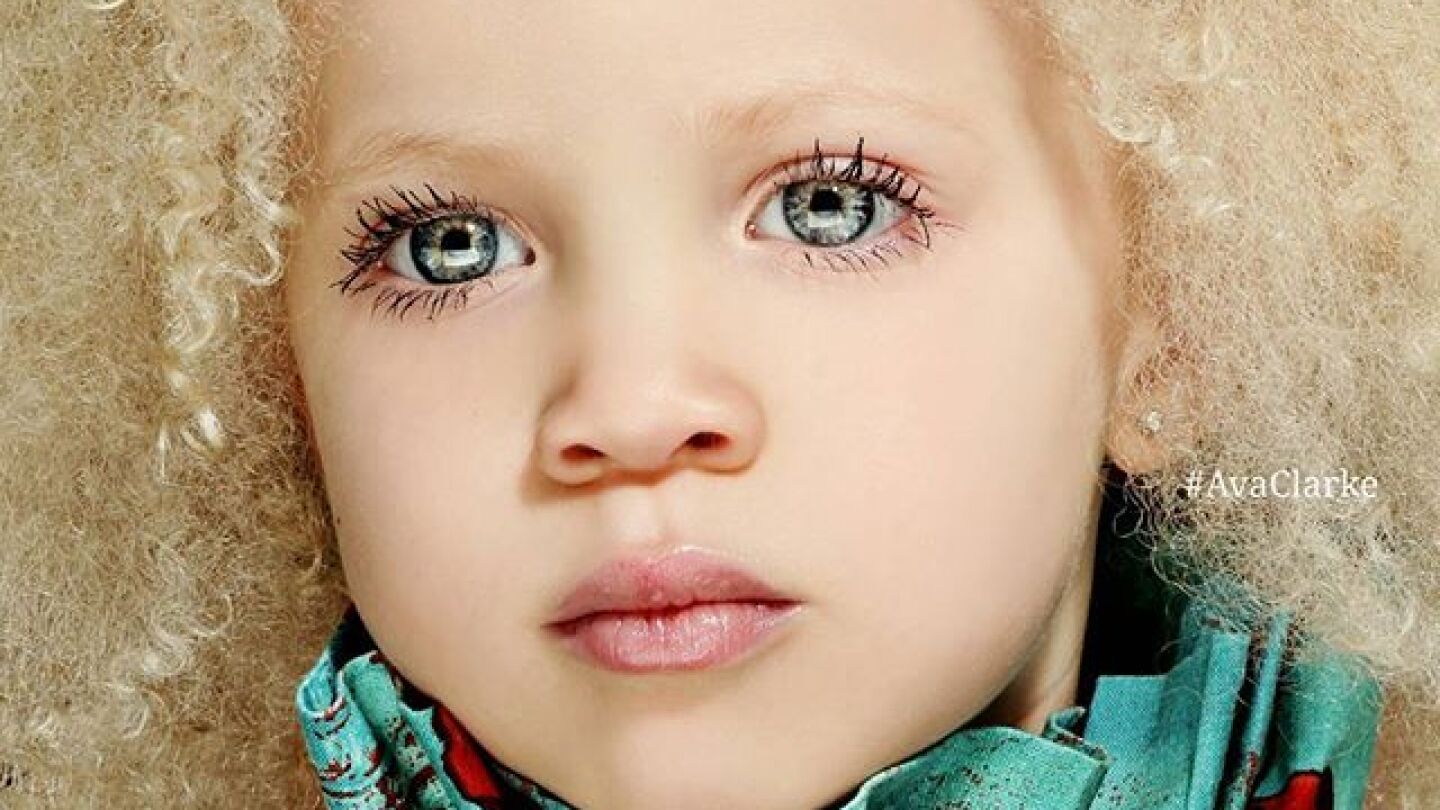 Una ni&ntilde;a albina de raza negra revoluciona el mundo de la moda