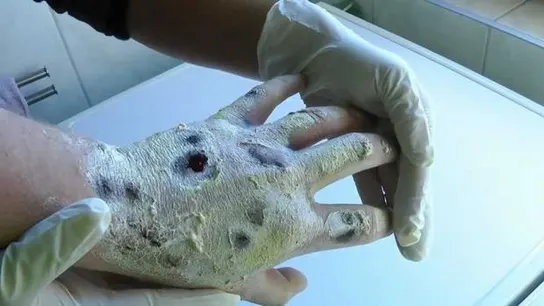 Los graves efectos que produce el consumo de 'Krokodil', una peligrosa nueva droga Los graves efectos que produce el consumo de 'Krokodil', una peligrosa nueva droga