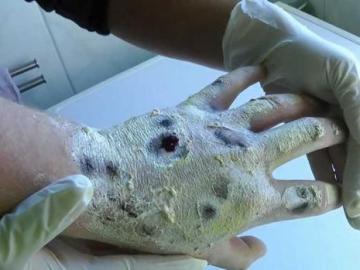 Los graves efectos que produce el consumo de 'Krokodil', una peligrosa nueva droga Los graves efectos que produce el consumo de 'Krokodil', una peligrosa nueva droga