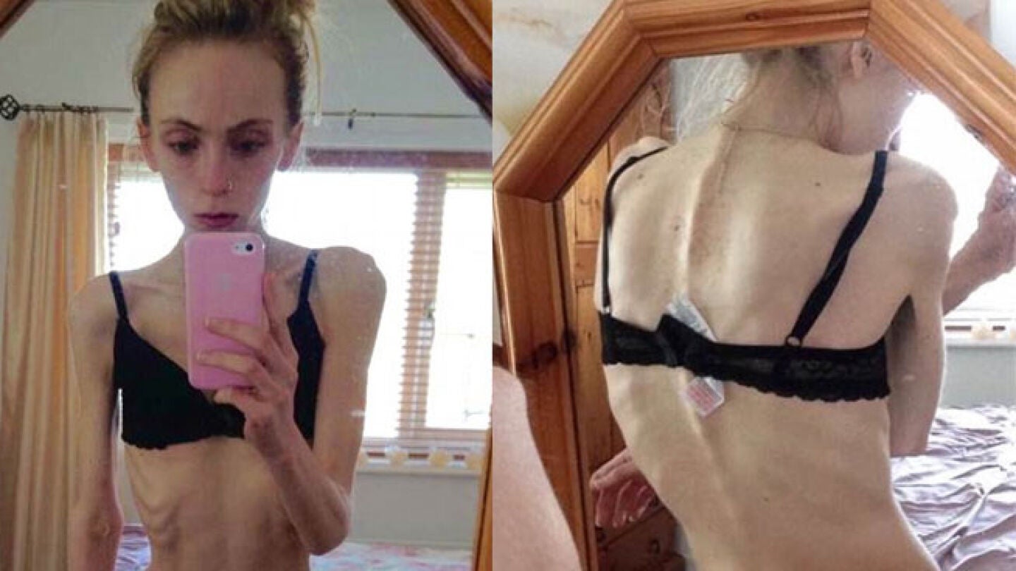 Pide ayuda para salvar a su hija, con anorexia nerviosa desde hace cuatro a&ntilde;os