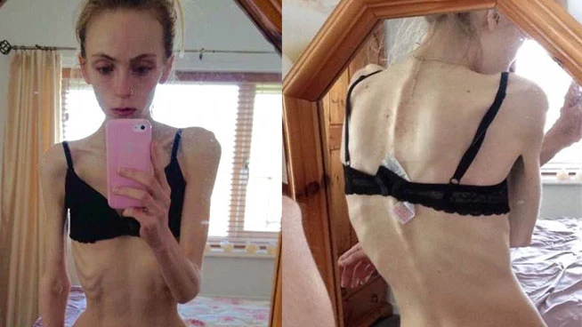 Pide ayuda para salvar a su hija, con anorexia nerviosa desde hace cuatro años Pide ayuda para salvar a su hija, con anorexia nerviosa desde hace cuatro años