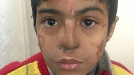 El niño con la nariz reimplantada El niño con la nariz reimplantada