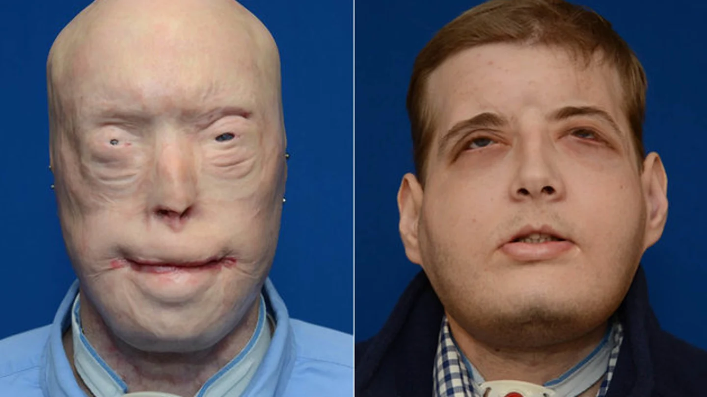 Un año después de la cirugia así es como se ve Patrick Hardison Un año después de la cirugia así es como se ve Patrick Hardison