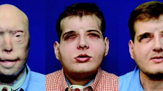 Frame 19.108913 de: Se cumple un año de la realización del primer trasplante de cara completo Frame 19.108913 de: Se cumple un año de la realización del primer trasplante de cara completo