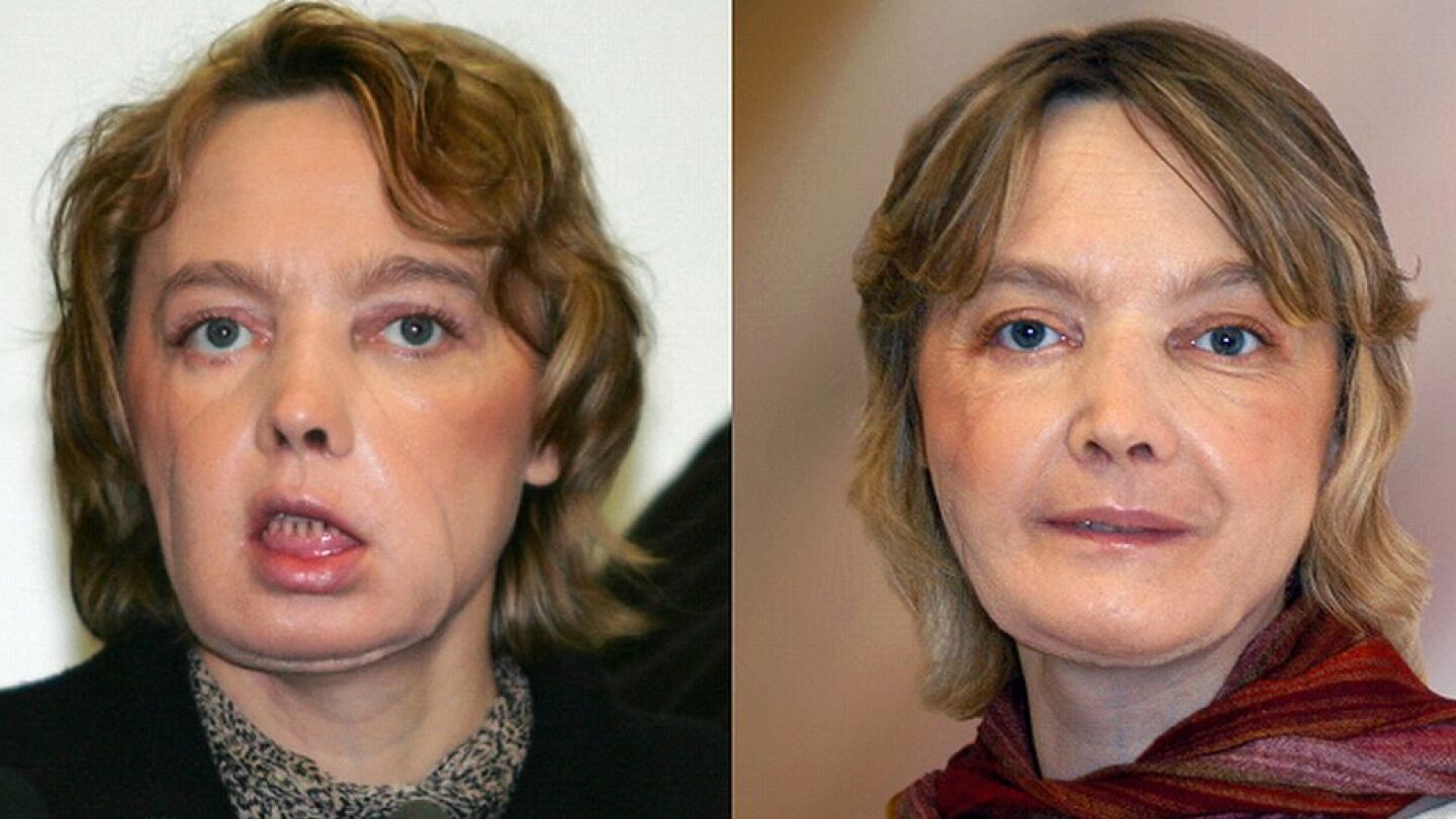 Isabelle Dinoire