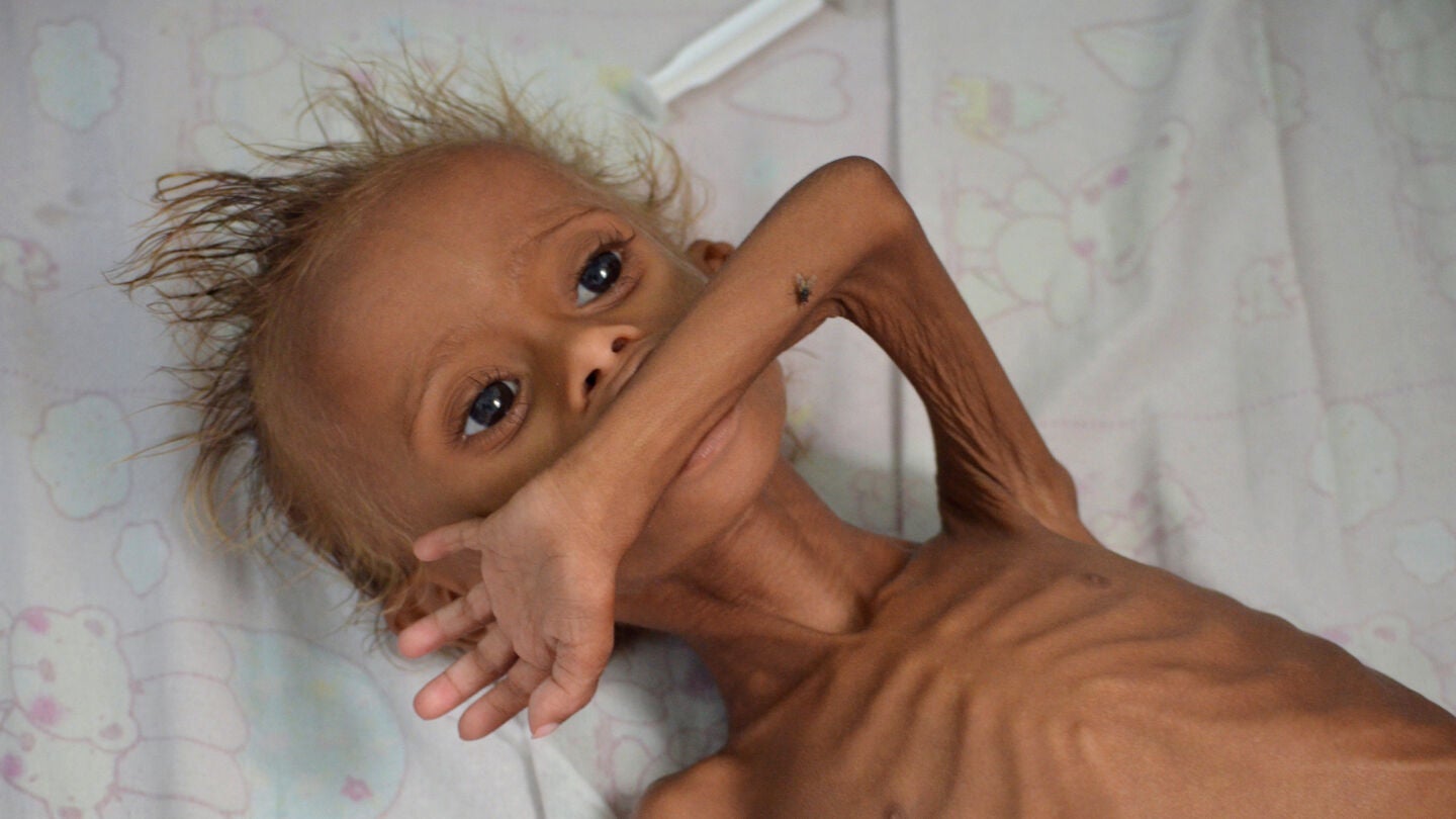 Un ni&ntilde;o yemen&iacute; desnutrido