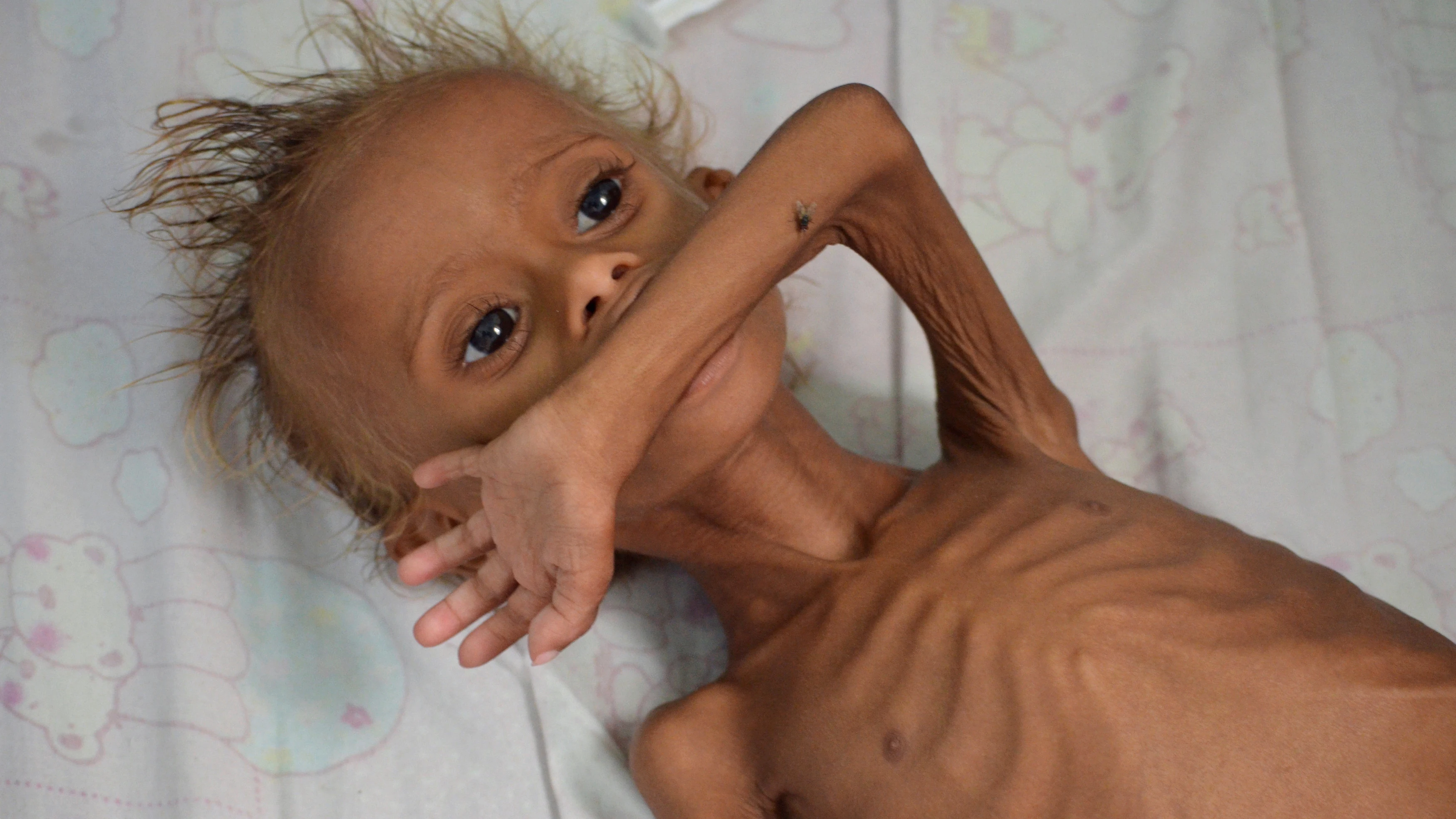 Un niño yemení desnutrido