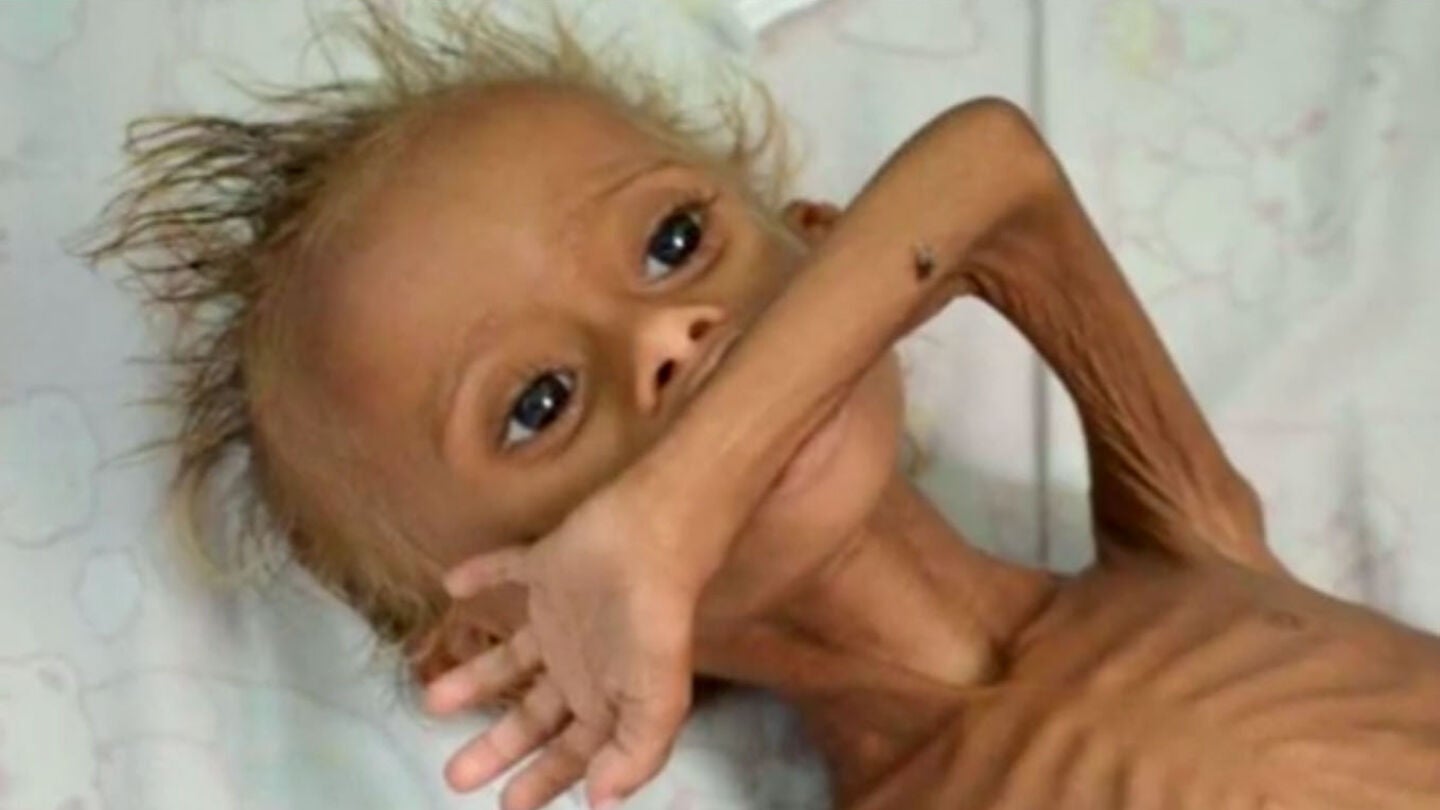 Un beb&eacute; desnutrido en Yemen