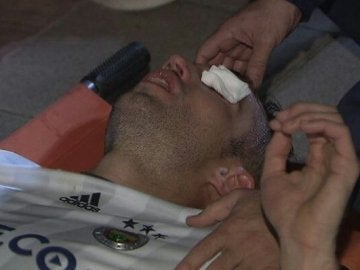 Van Persie, tras sufrir el codazo que casi le hace perder un ojo Van Persie, tras sufrir el codazo que casi le hace perder un ojo