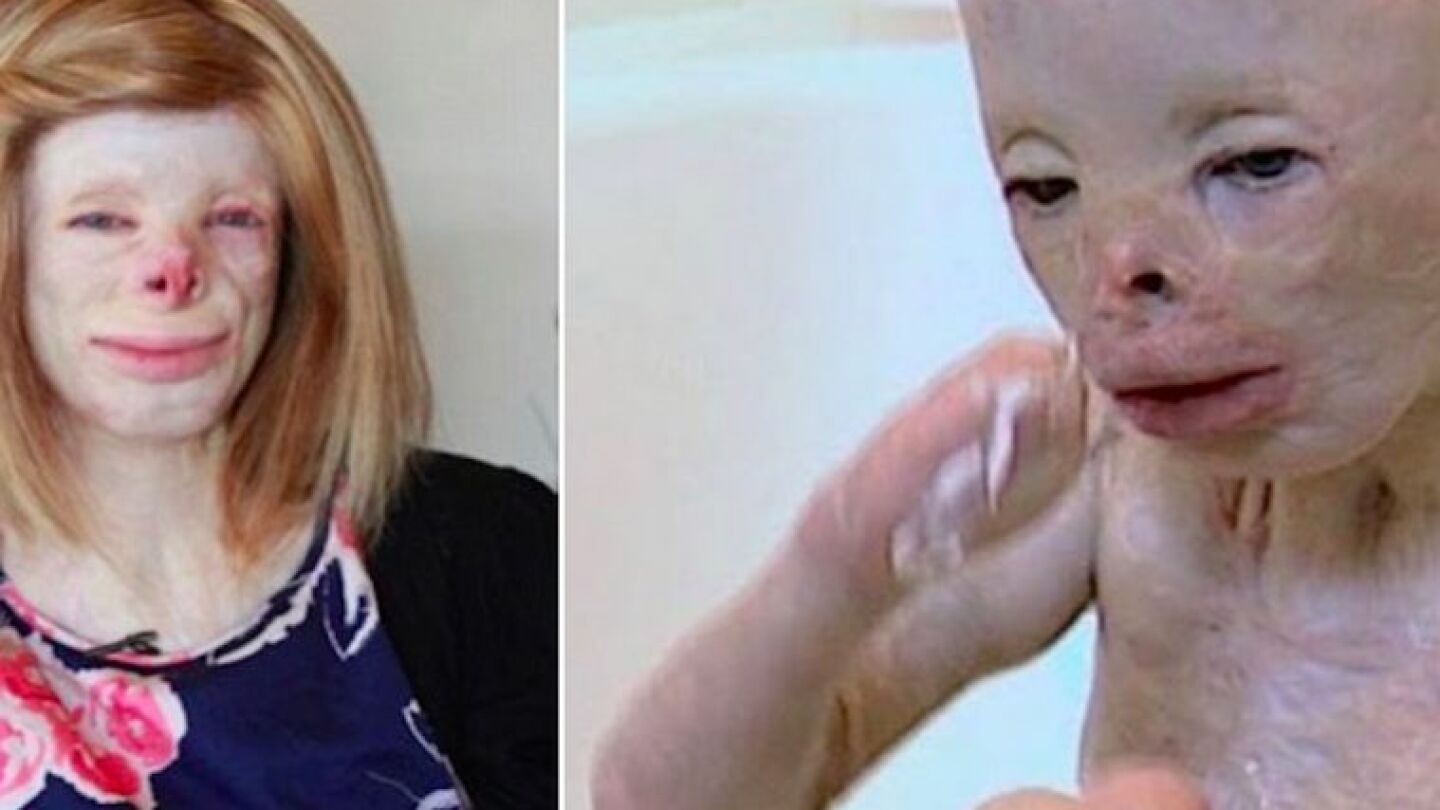 La joven Terri Cavelbert tras las cirug&iacute;as 
