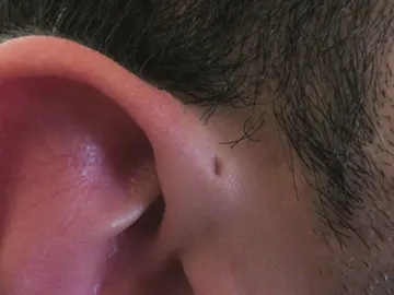 'Preauricular sinus' en la oreja derecha 'Preauricular sinus' en la oreja derecha