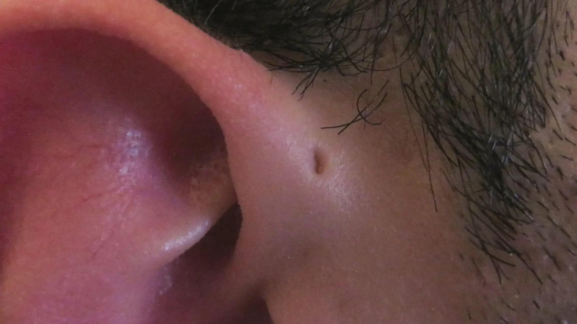 'Preauricular sinus' en la oreja derecha