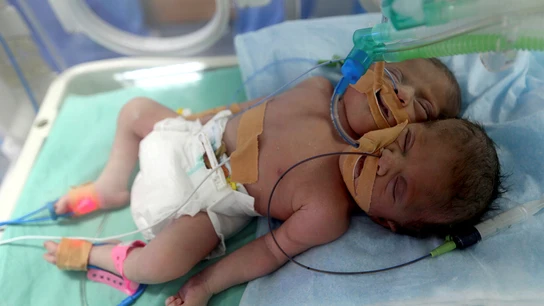 Las dos gemelas siamesas nacidas en Gaza Las dos gemelas siamesas nacidas en Gaza