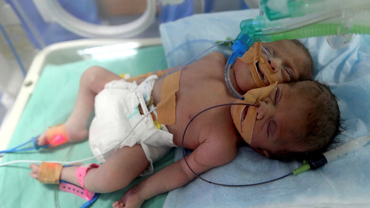 Las dos gemelas siamesas nacidas en Gaza Las dos gemelas siamesas nacidas en Gaza