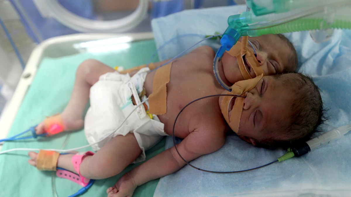 Las dos gemelas siamesas nacidas en Gaza Las dos gemelas siamesas nacidas en Gaza