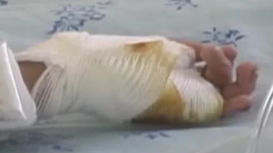 Una de las manos del niño quemado por su madre Una de las manos del niño quemado por su madre