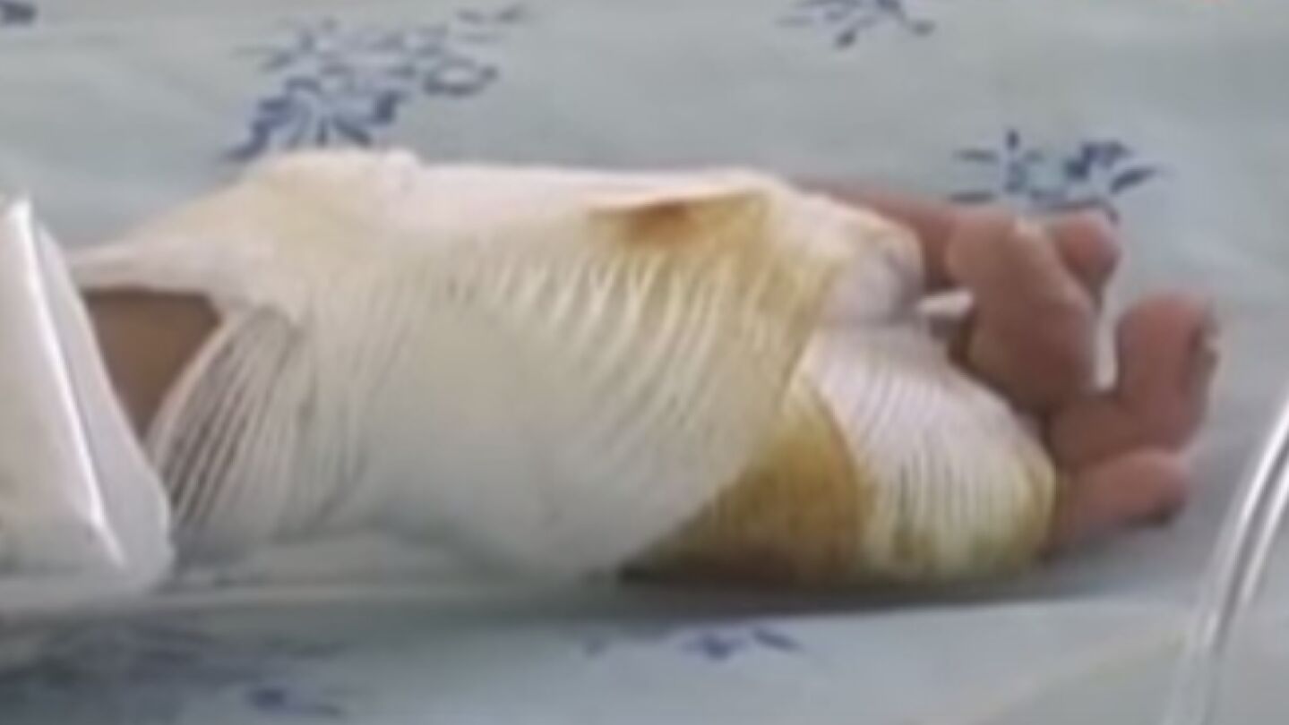 Una de las manos del ni&ntilde;o quemado por su madre