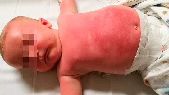 Bebé hospitalizado tras usar una crema protectora Bebé hospitalizado tras usar una crema protectora