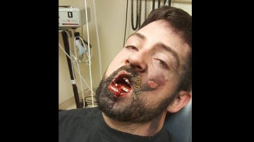 Andrew Hall perdió siete dientes