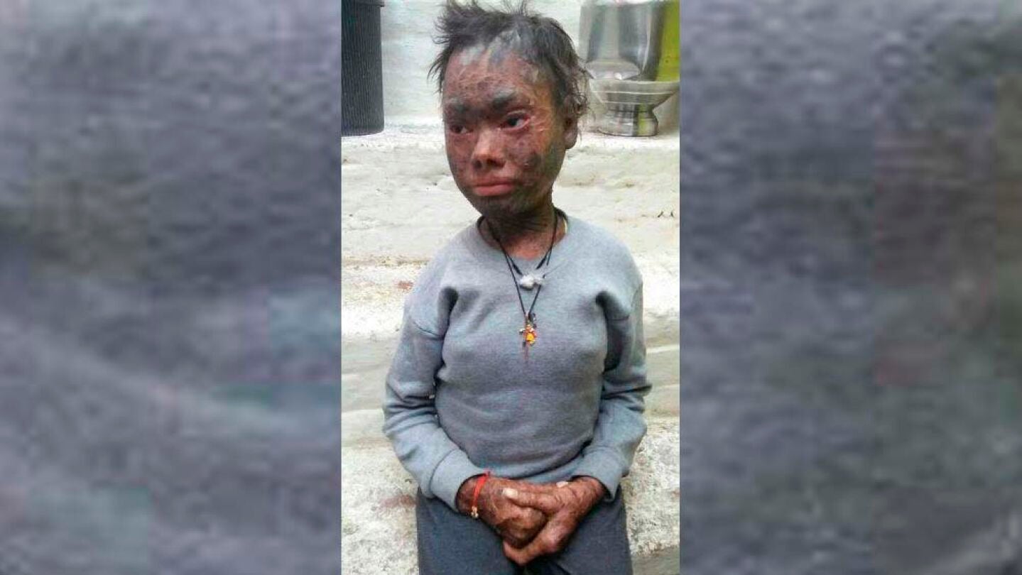 Shalini padece una enfermedad que le hace tener 'piel de serpiente'