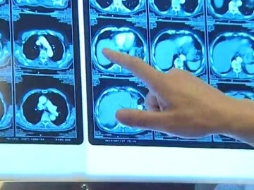 Frame 40.742397 de: El número de casos de cáncer registrados en España en 2015 supera los estimados para 2020