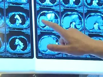 Frame 40.742397 de: El número de casos de cáncer registrados en España en 2015 supera los estimados para 2020 Frame 40.742397 de: El número de casos de cáncer registrados en España en 2015 supera los estimados para 2020