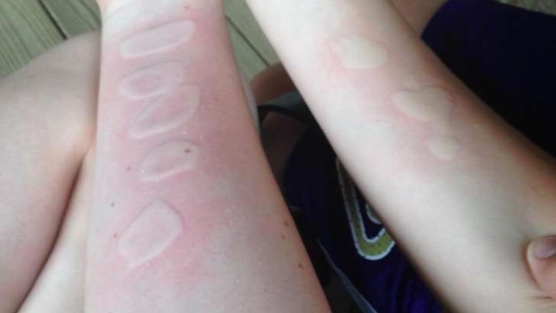 Cicatrices que deja en los brazos el reto 