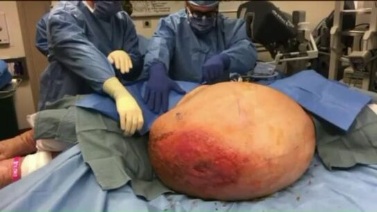 Una mujer con sobrepeso descubre que tiene un tumor de m&aacute;s de 63 kilos