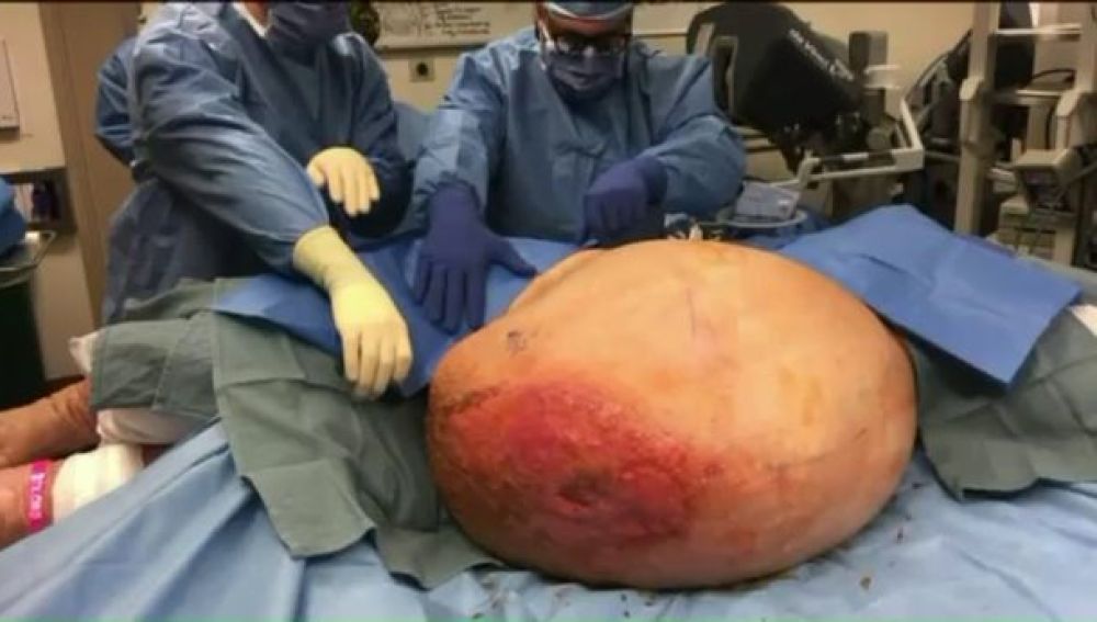 Una mujer con sobrepeso descubre que tiene un tumor de más de 63 kilos